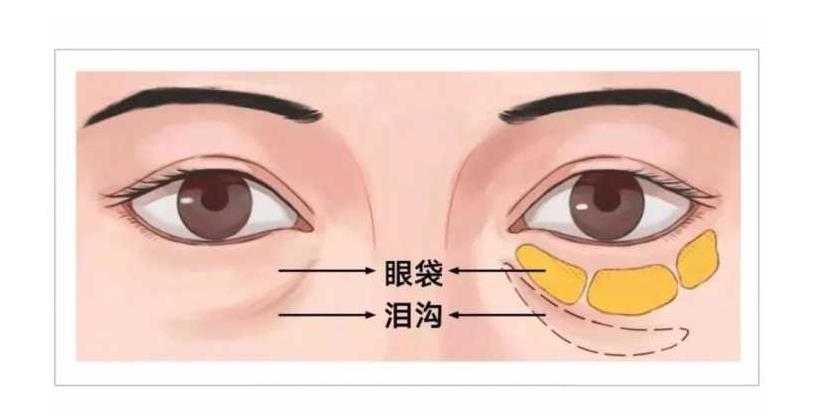 刘光晶医生怎么样？天津公立医院整形科室专家简介_泪沟填充案例