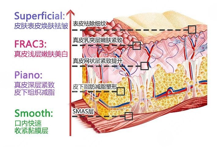 fotona欧洲之星多少钱？收费价格\维持时间\注意事项