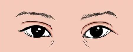 上海九院茹做双眼皮怎么样？真人做双眼皮手术全过程介绍！