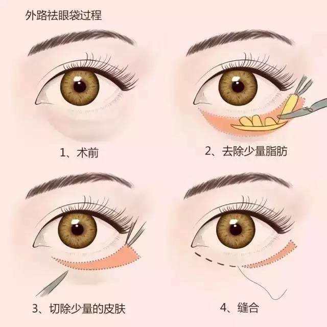 北京哪家医院去眼袋手术可靠？北京美莱技术点评_案例一览