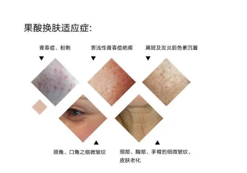 果酸换肤前后对比照片分享！皮肤细腻有光泽~