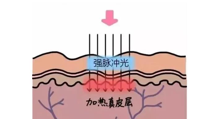 激光美白皮肤一次多少钱？价格明细、费用影响因素等汇总！