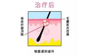 丁爽瘢痕综合调节很擅长吗？哈医大一院医生简介\实操案例