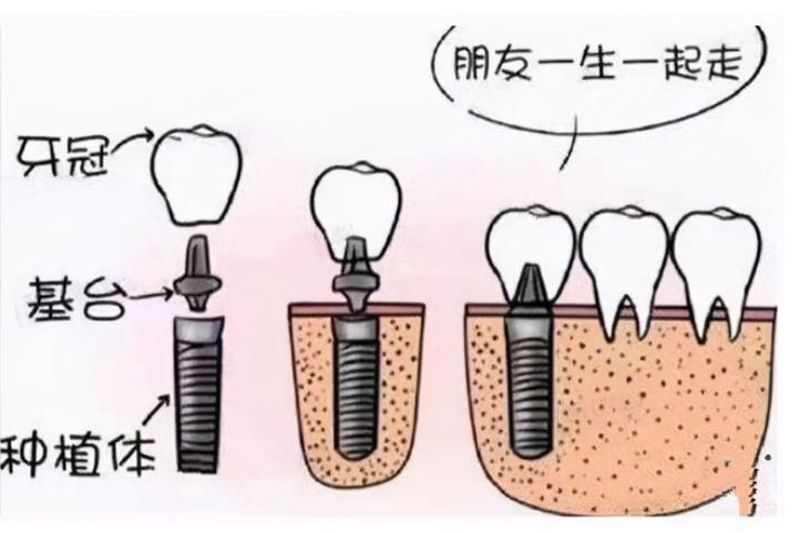 北京博爱口腔门诊部怎么样？刘鹏医生简介\种植牙案例详情