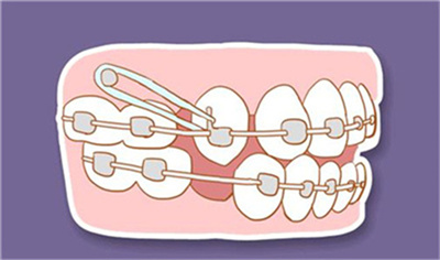 牙博士正畸费用明细怎么样？2023年价目表更新！