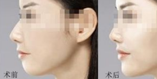 膨体隆下巴过程，手术前后需要注意的方面！