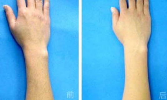 光子脱毛与激光脱毛的区别是啥，，多久可以做一次！