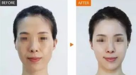 硅胶隆鼻前后对比，前后效果对比详解！