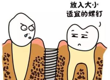 上海极橙齿科种植牙多少钱?收费贵不贵?种植牙案例