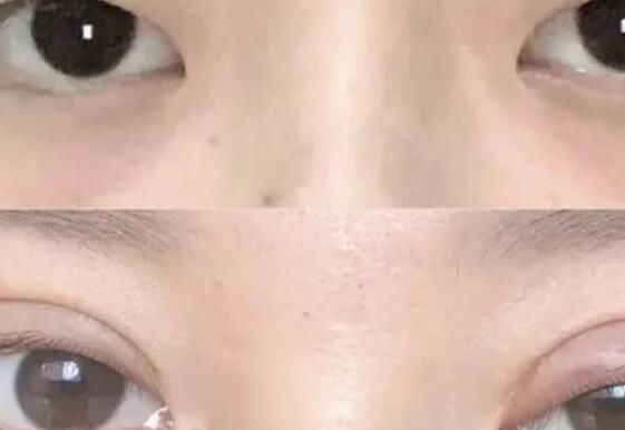 男士割双眼皮好吗，打造迷人双眼！
