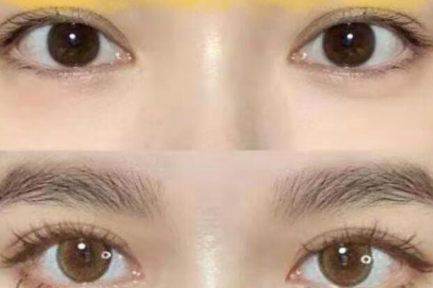 拉双眼皮手术全过程，有哪些方法！