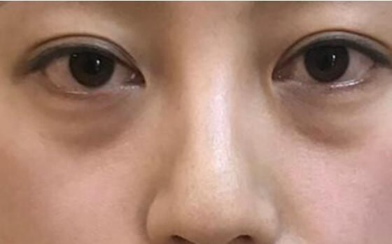 北京超声法去眼袋哪里好，附案例介绍！