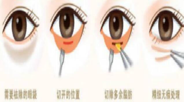 怎样抽脂去眼袋，科学选择有哪些！