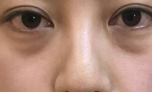 眼袋及祛眼袋的详细介绍，价格合适吗！