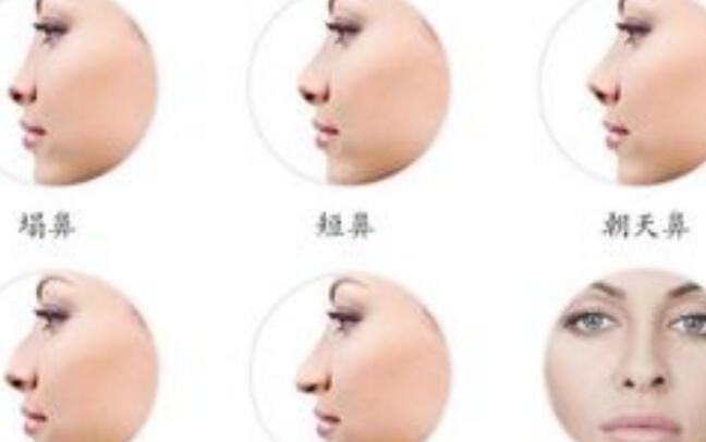鼻头塑形是什么意思，了解主流选择！