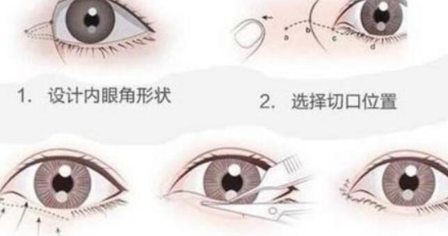 开内眼角有后遗症吗，是暂时性的吗！