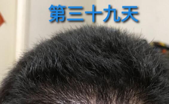 掉头发和自身有何原因，主要因素有哪些!