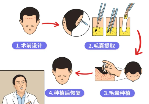李宇飞植发怎么样？内附医生信息及技术测评！