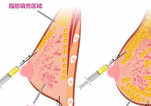 上海施悦脂肪隆胸怎么样?医生信息与技术公开