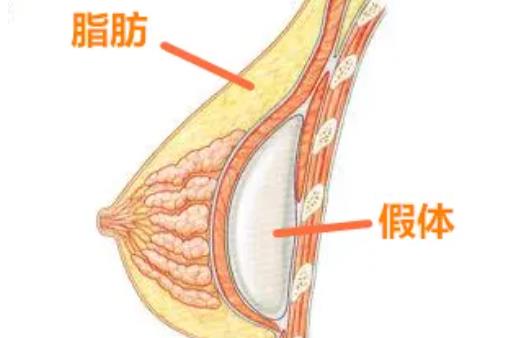 上海大美医疗美容门诊部隆胸怎么样？技术优势是什么？隆胸项目科普