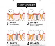 上海雅洁口腔医院种植牙多少钱？价格在3000起！内附医生信息