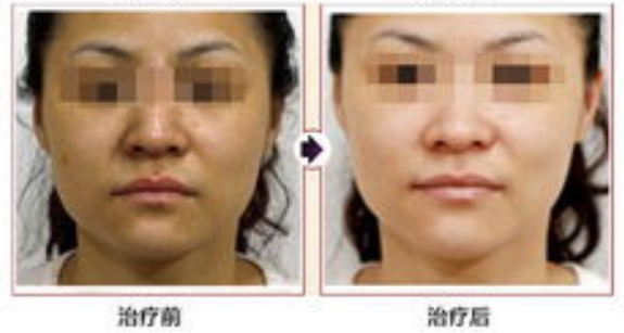 皮肤偏黄如何美白，有效方法和建议！