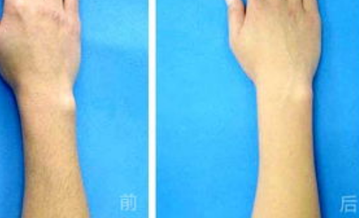 怎么脱毛好，如何选择!