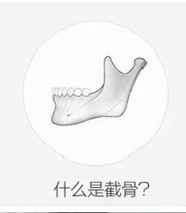 杨君毅磨骨多少钱一个部位？磨骨手术疼不疼？来看真人术后感受吧