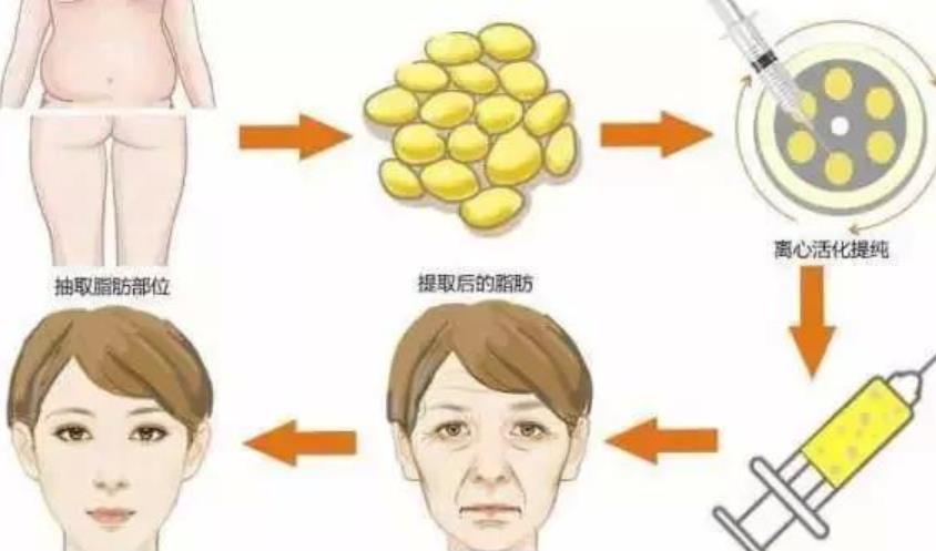 上海袁玉坤面填效果如何？坐诊医院概况介绍！面部填充全过程记录