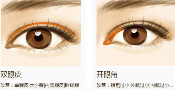 开眼角双眼皮手术，过程与效果！