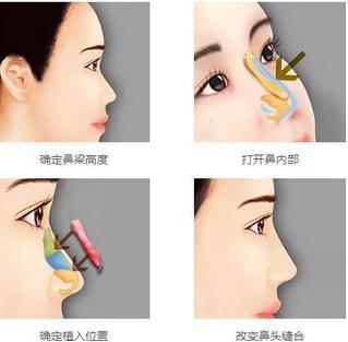 华美叶丽萍做鼻子价格是多少?医生个人简介附上!