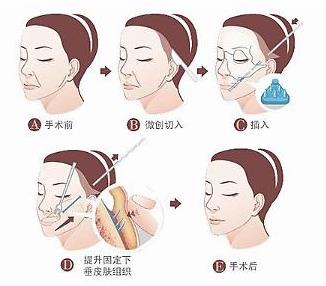 医美拉皮正规医院多少钱?价格费用明细抢先看!