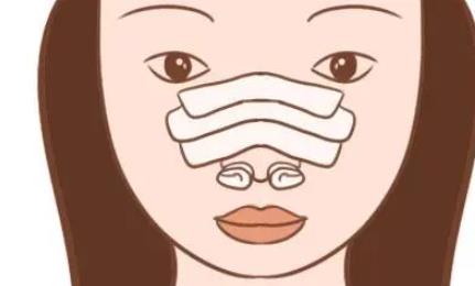 广州恒美做鼻子做的好的医生名字|谭敏峰医生做隆鼻手术全过程记录！