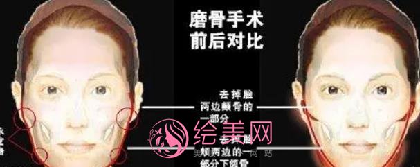 上海韩镜郑志雄磨骨擅长什么？医生技术优势是什么？价格表