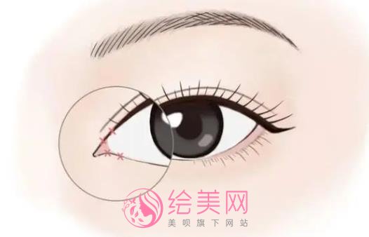 上海宏明医疗美容门诊部开眼角手术技术好不好？王小民、李增光资料介绍！