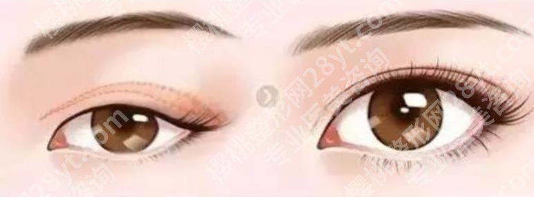 上海微加医疗美容门诊部张亚伦怎么样？真人做双眼皮手术案例图曝光！