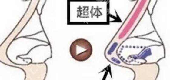 上海娜慕医疗美容医院肋骨鼻子成功率高吗？院内口碑医生推荐哦！