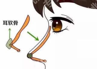 上海圣娅医疗美容医院刘春伟怎么样？医生简介|隆鼻案例展示！