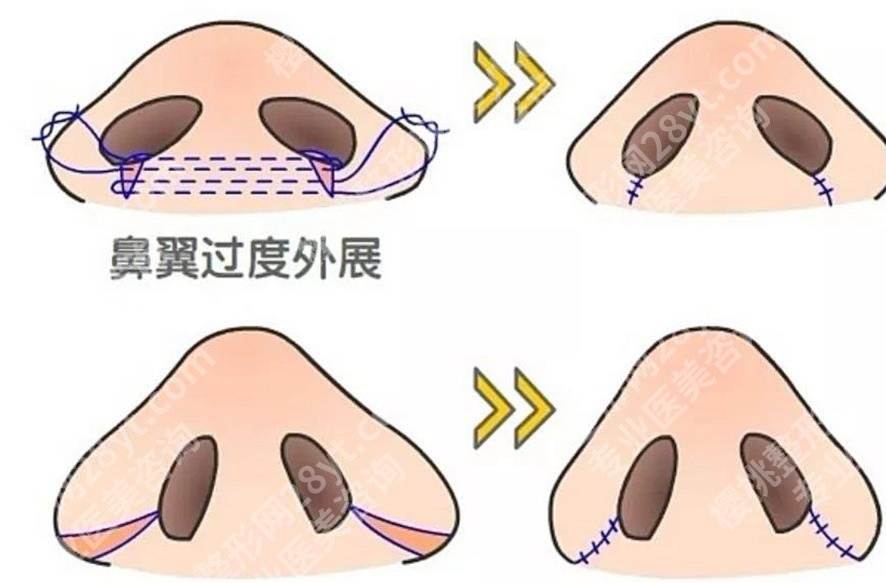 上海韩镜医疗美容医院做隆鼻多少钱?鼻部整形相关项目及价格表参考