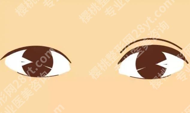 上海千美双眼皮谁做得好？口碑医生推荐！双眼皮案例