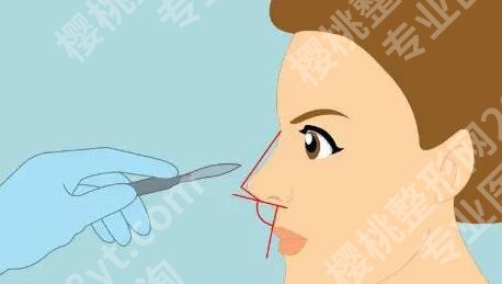 上海韩镜医疗美容医院鼻部整形多少钱？价格影响因素有哪些？