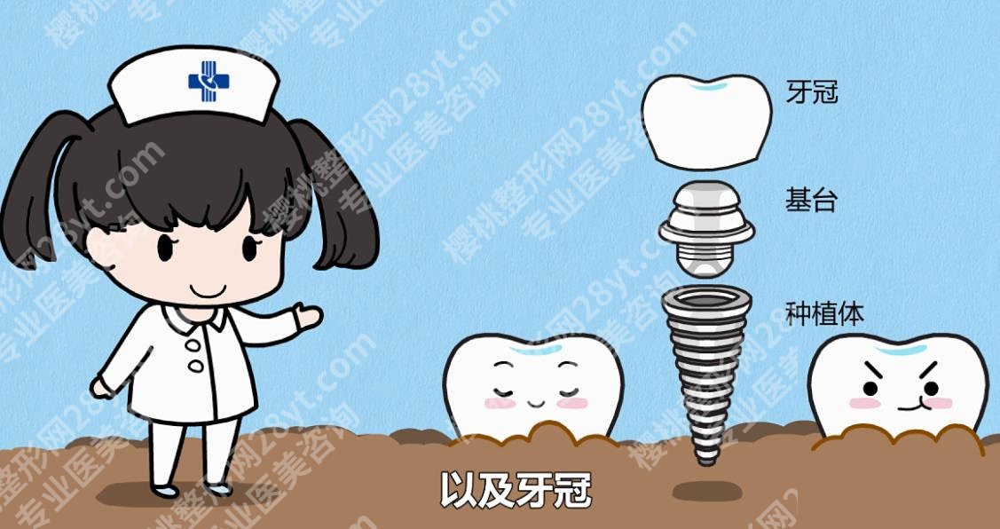 上海圣康口腔种植牙怎么样？院内口碑医生实操牙齿种植案例图曝光！