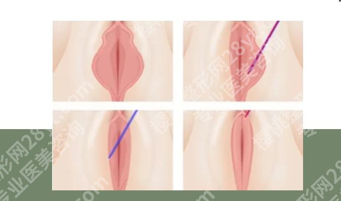上海柏荟医疗美容门诊部做私密手术好吗？技术特色、价格表一览！