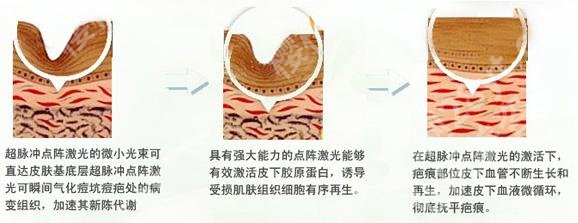 上海禾新医院医疗美容科祛痘怎么样？院内技术优势、案例图反馈！