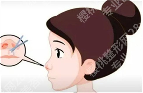 上海一美整形外科医院软骨隆鼻价格贵吗？专家医生上线了，案例测评