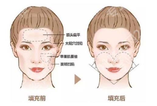 上海艺星脂肪填充怎么样？实力医生有谁？面部脂肪填充案例