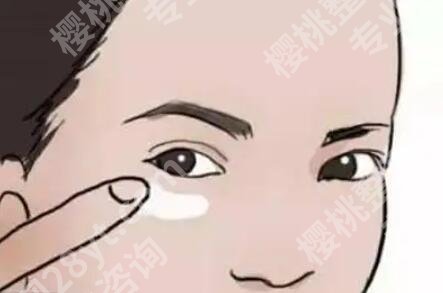 上海艺星医疗美容医院去眼袋多少钱？效果好不好？戳进来了解一下吧