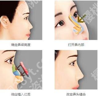 上海韩镜医疗美容医院鼻部整形怎么样？真人案例、价格表曝光！