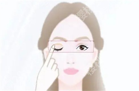 上海瑞欧医疗美容双眼皮价格贵吗？点击看医生，案例