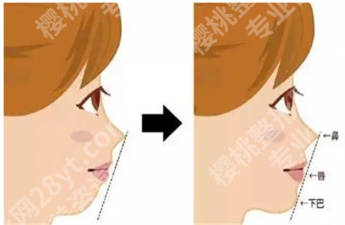 上海华美鼻综合多少钱?医生怎么样?鼻综合案例参考